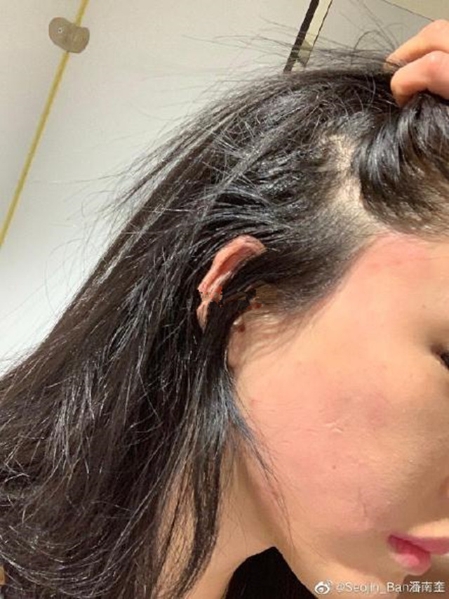 网红潘南奎与老板发生争吵被打,脸部红肿受伤严重