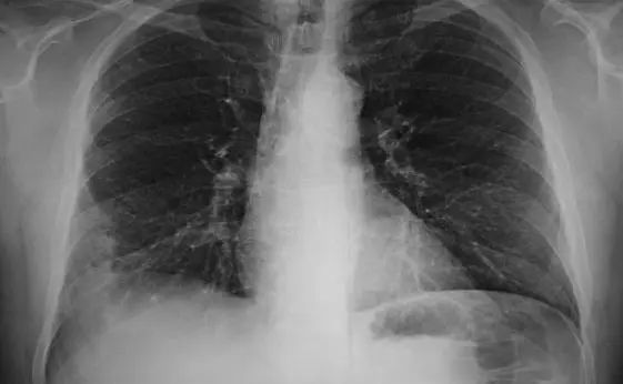 36岁女子,查出肺癌,虽不抽烟,但一个坏习惯,同样把肺伤透了
