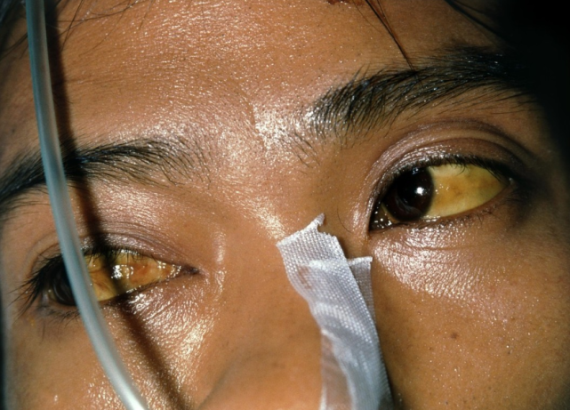 表现二:眼睛发黄正常情况下,我们的脸部皮肤应该是红润有光泽的,反之