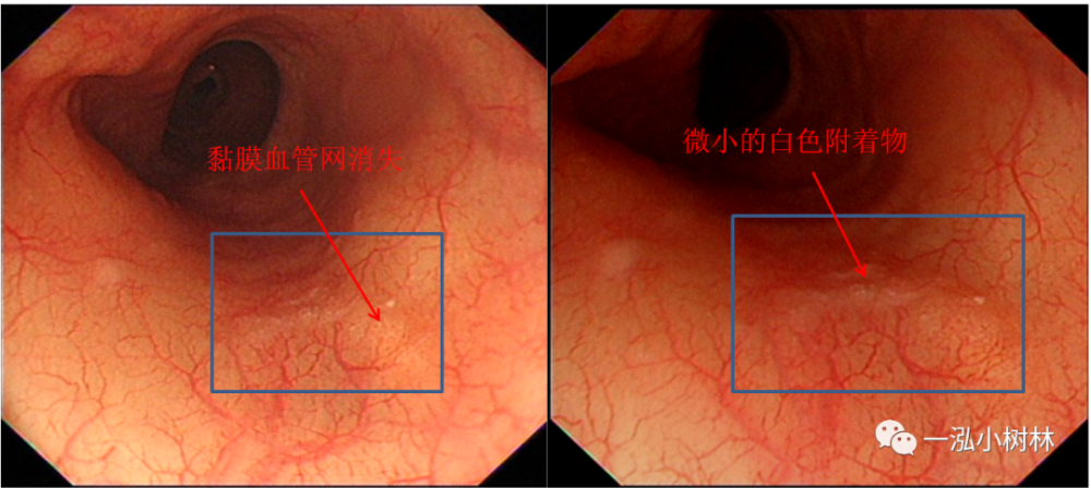 早期食管癌内镜诊断 腾讯新闻