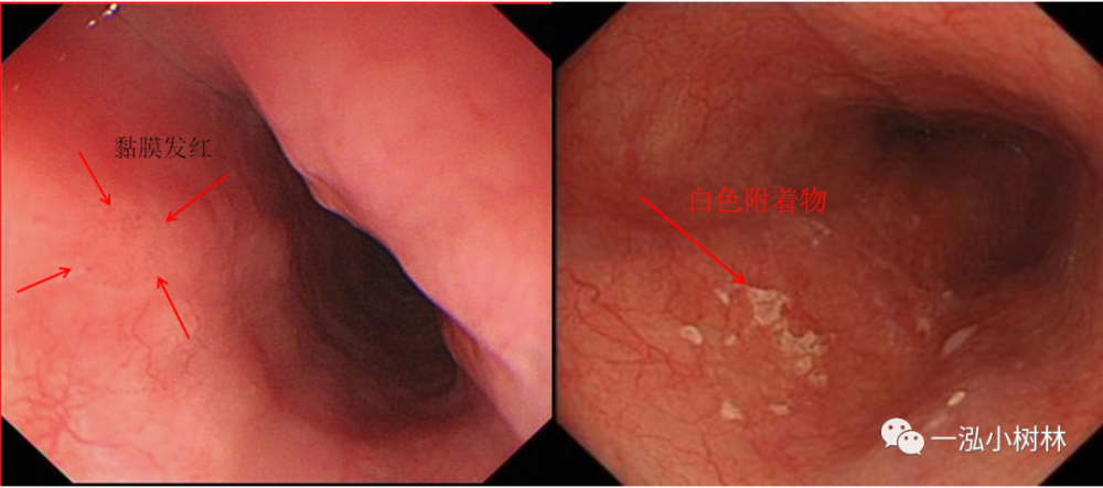 早期食管癌内镜诊断