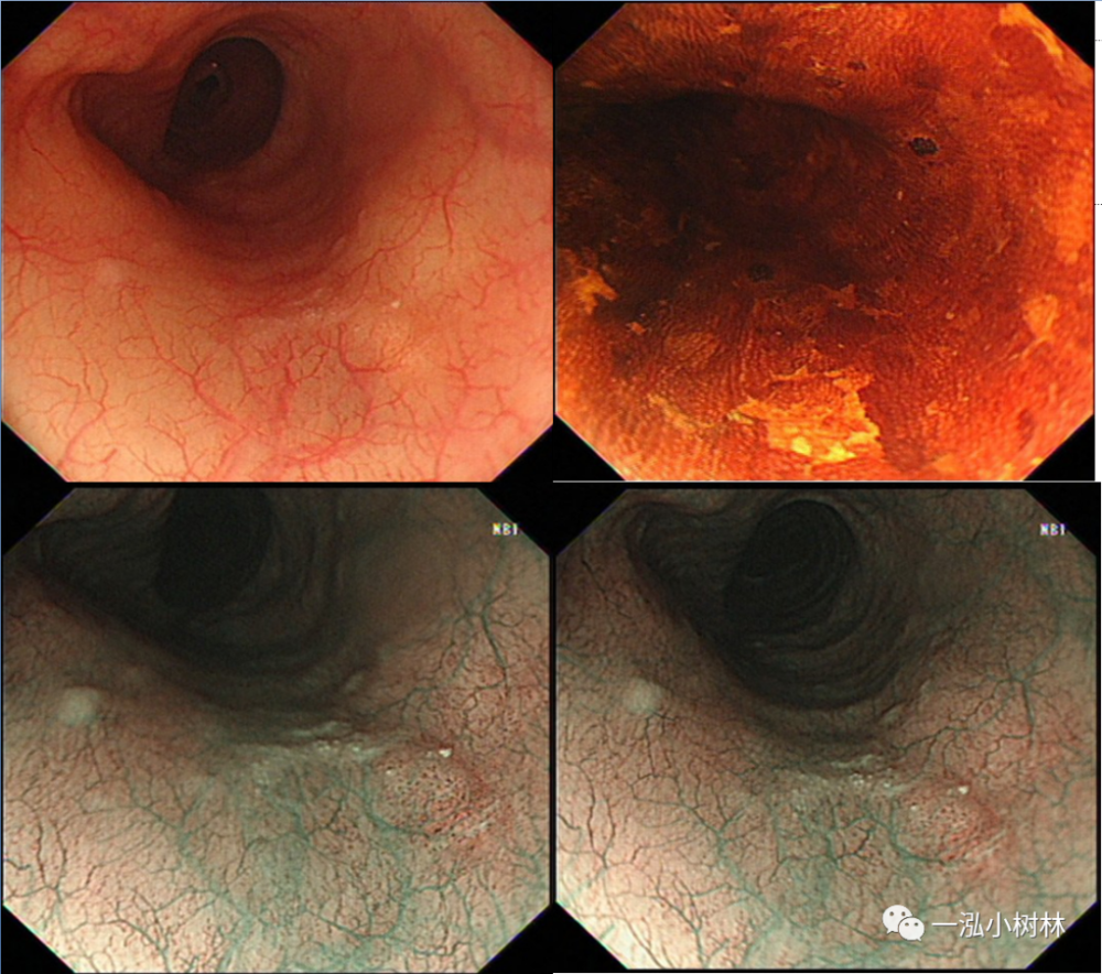 早期食管癌内镜诊断