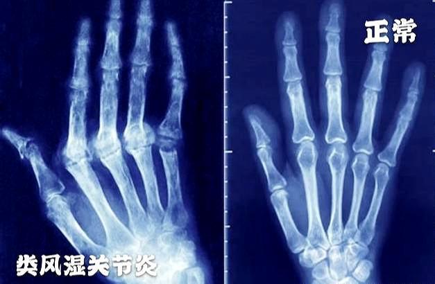 手指僵硬 疼痛 多由这五种疾病导致 如何诊断治疗 医生告诉您 腾讯新闻