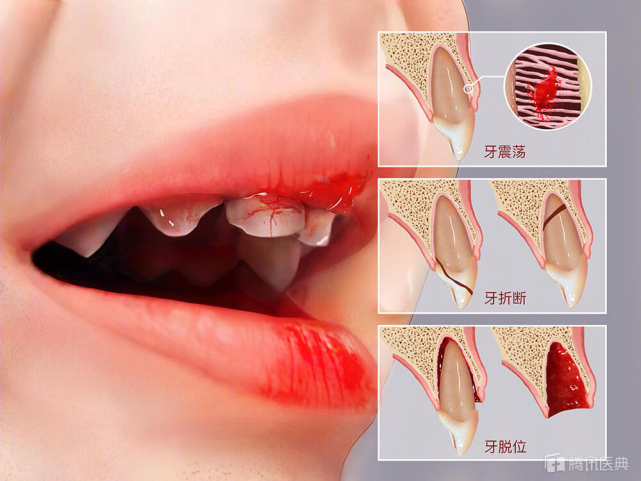 牙齿受伤怎么办这3点常识一定要记好处理不当会延误治疗别大意