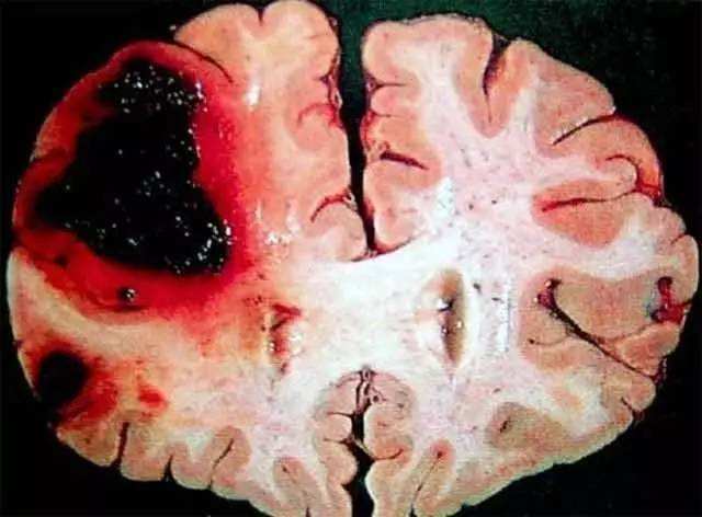 脑溢血早期5个症状,出现一个,都要引起重视,指的是哪几个症状?
