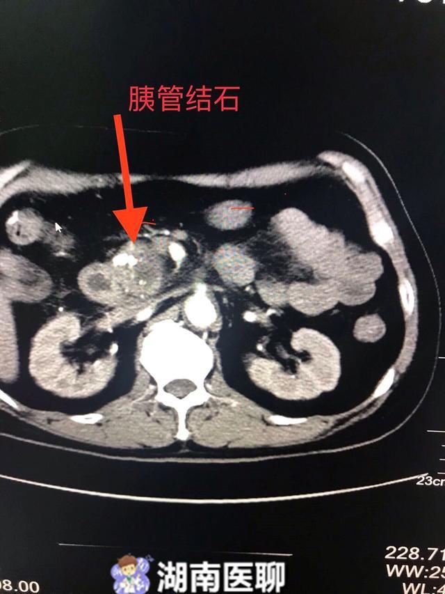 这是吃出来的病导致慢性胰腺炎的原因有3点您还在嘴贪吗