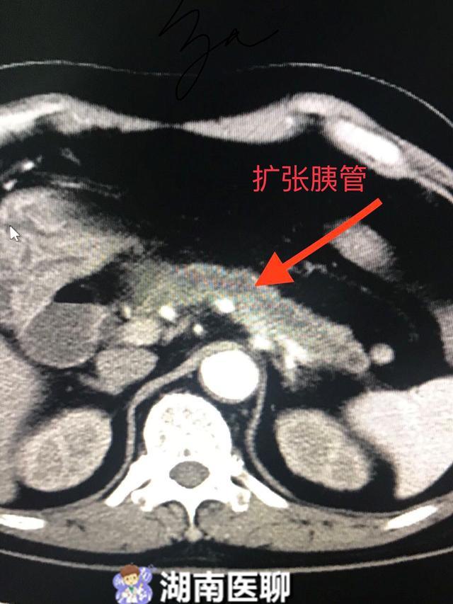 如果是有胰管结石,胰管扩张,可外科手术治疗或内镜治疗.