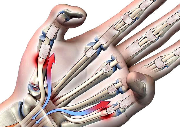 大拇指腱鞘炎多见于这两类人群该如何治疗医生给您说清楚
