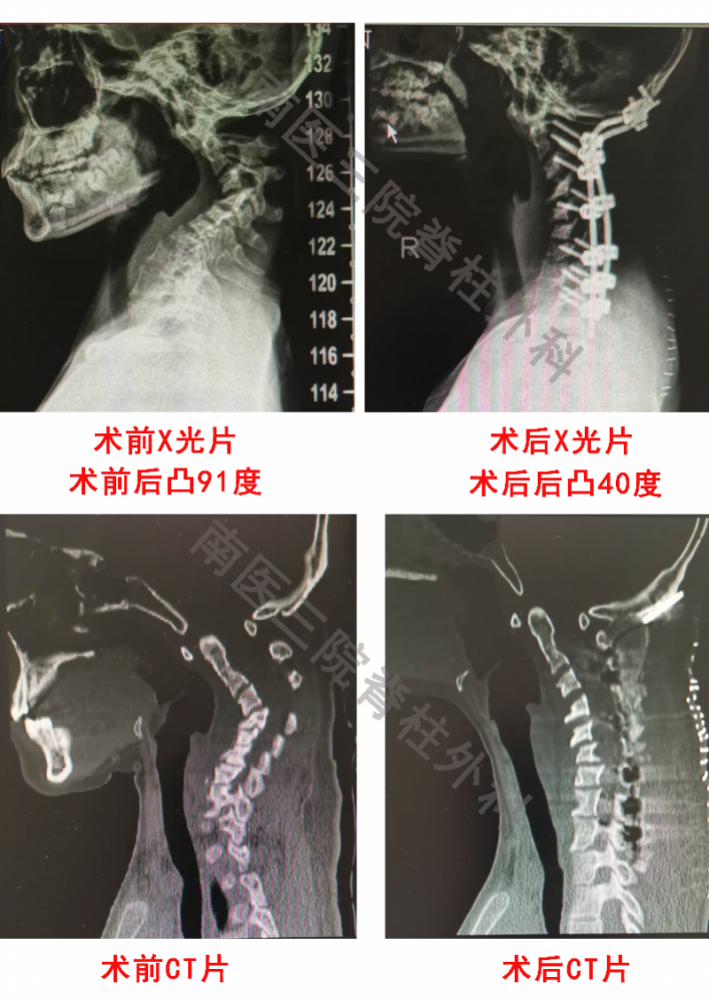 感觉酸痛,检查发现颈椎已严重畸形,后凸超90度,近日,小青在广州南方