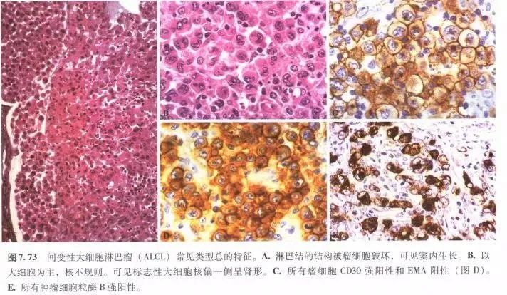 间变性大细胞淋巴瘤 Alk阳性 腾讯新闻