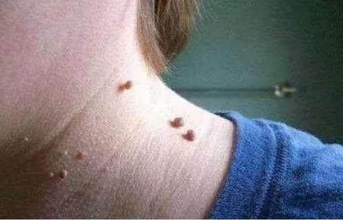 尖尖为什么祛除疣体还会复发?看完这个让你尖尖一次性消失