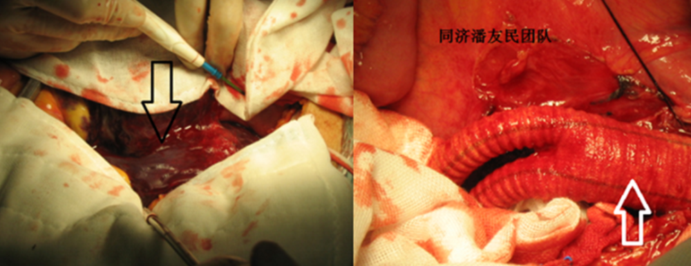 图7:剖腹探查时显示破裂性腹主动脉瘤的覆膜后血肿(黑箭头所示),替换