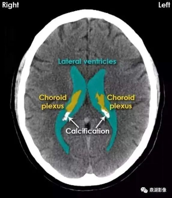 中央溝caudate nuclei:尾狀核;lentiform nuclei:豆狀核;thalamus