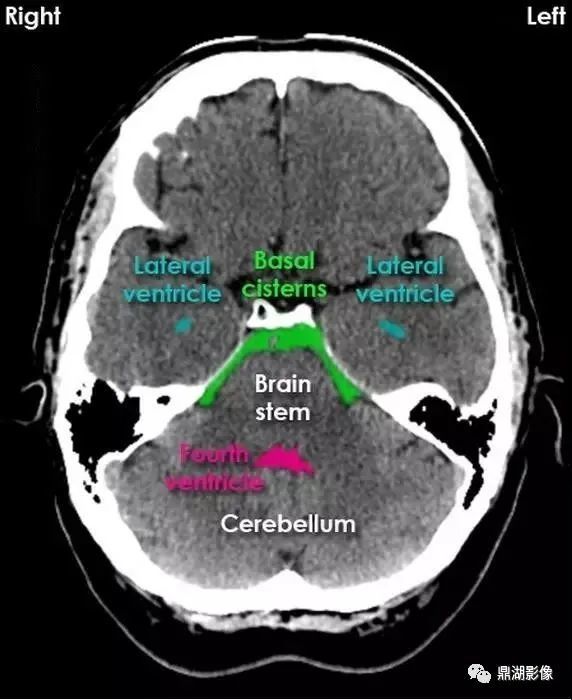 超赞的高清颅脑ct解剖彩色图谱