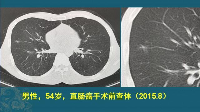 肺纤维灶是什么意思 会长成肺癌吗 该怎么办更安全 腾讯新闻