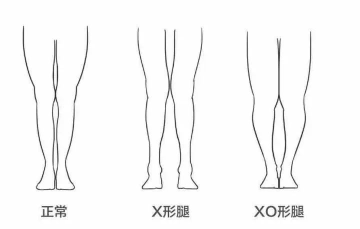 上一期我們講到x型腿怎麼矯正的問題,激起了一大波粉絲對於