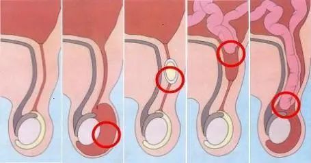 下腹部反复凸出包块,可能得了腹股沟斜疝