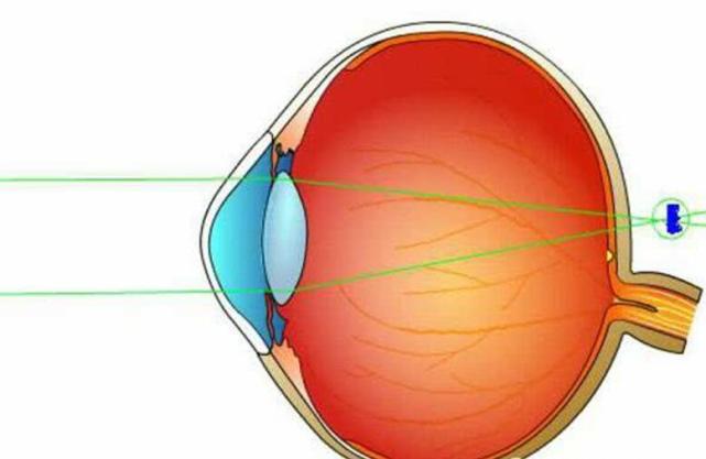 成像於視網膜之後的一種屈光狀態,當眼球的屈光力不足或其眼軸長度不