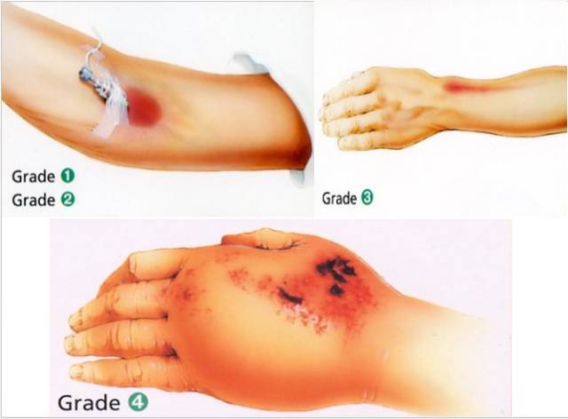 当出现药物外渗后,轻者在渗出区域的皮肤出现红斑,肿胀,皮下硬结及