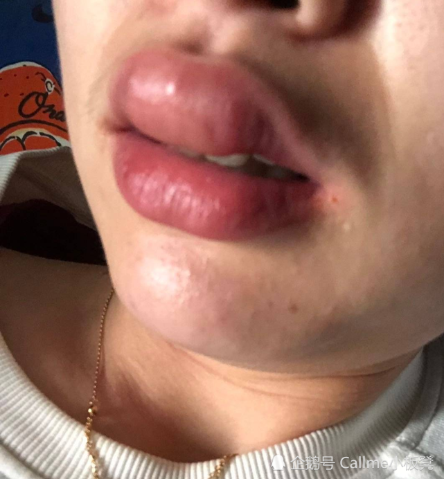 我一个同学和我住一个宿舍,有一天蚊子咬了我的屁股,又咬了她的嘴唇