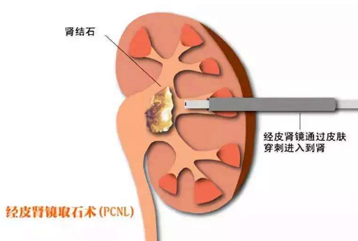 输尿管结石超过一旦超过这个时间就很难排出来了