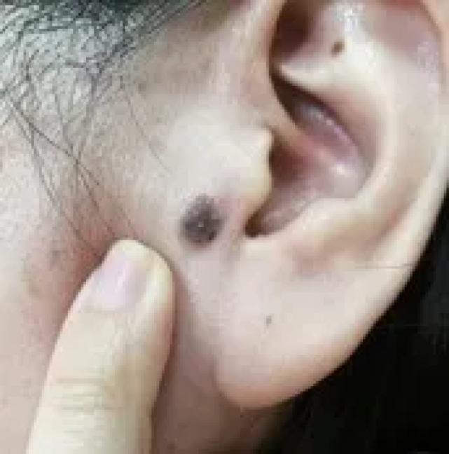 黑痣癌变,67从发病到去世不到两个月,医生:长在这些地方的痣都要切!