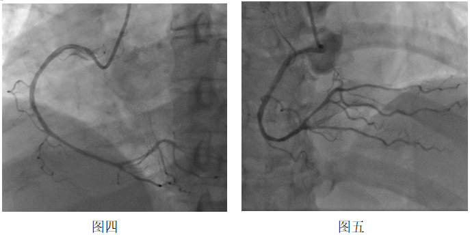 冠脉供血呈右优势型,冠脉走形区未见显著钙化影,冠状动脉整体偏细小