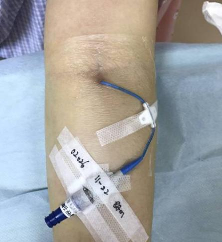 肿瘤患者化疗的"生命线"——picc管院外如何正确护理?