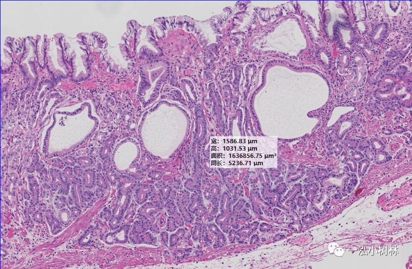 胃底腺型胃癌诊断与治疗(更新版)