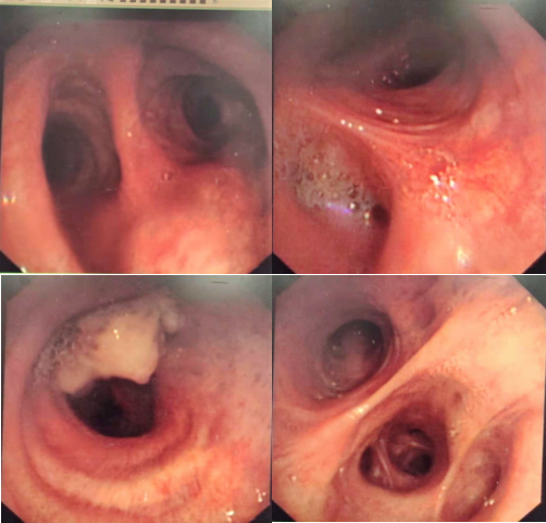 一例晚期肺鳞癌pfs超过26个月功臣是它