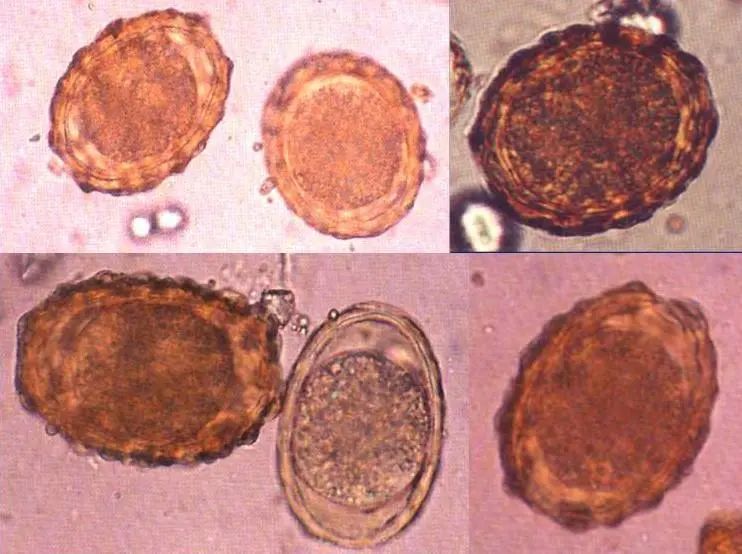 我可以肯定的给临床报似蚓蛔线虫并可见未受精蛔虫卵