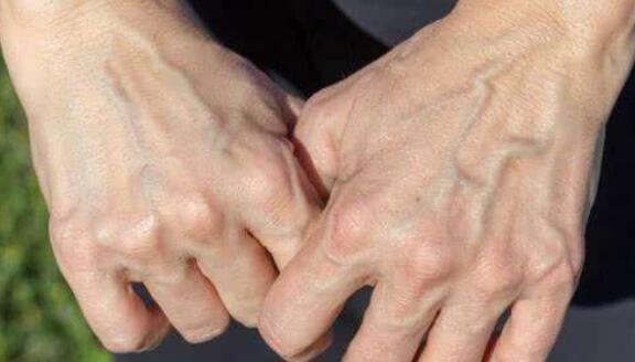 为什么有些人手背上的青筋又粗又明显,医生终于说出了事实!