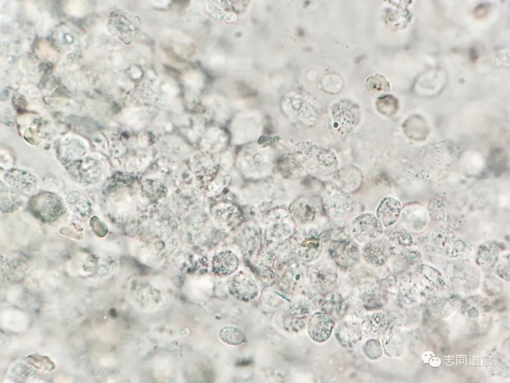 粪便里的肿瘤细胞长这样