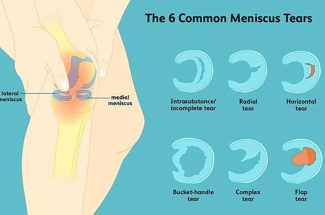 半月板撕裂后 医生为什么建议手术治疗 术后如何防止关节磨损 腾讯新闻