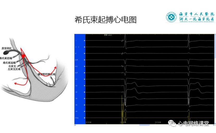 吉亚军老师-希氏束起搏心电图解析