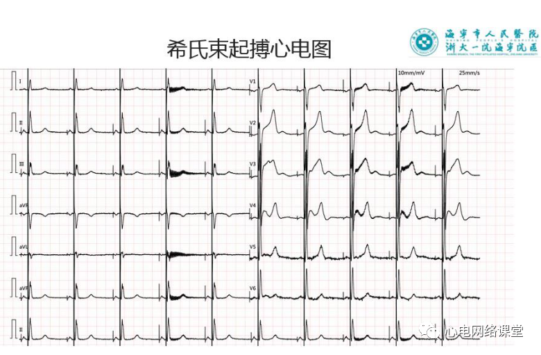 吉亚军老师-希氏束起搏心电图解析