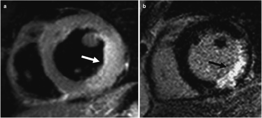 急性心肌梗死的影像学表现，高清图谱详解要点!_腾讯新闻