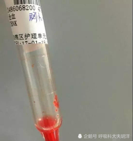 肺癌患者产生胸水不一定都是癌细胞转移 还有三个原因导致胸水 腾讯新闻