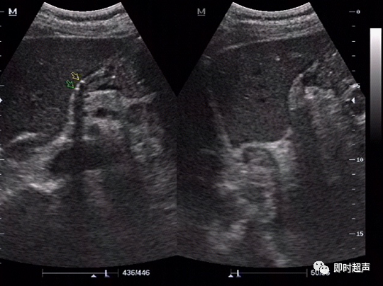 胃肠道穿孔超声检查诊断与定位_腾讯新闻