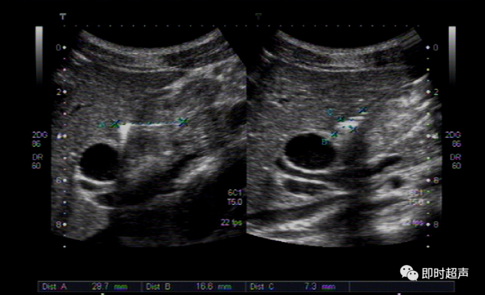 胃肠道穿孔超声检查诊断与定位_腾讯新闻