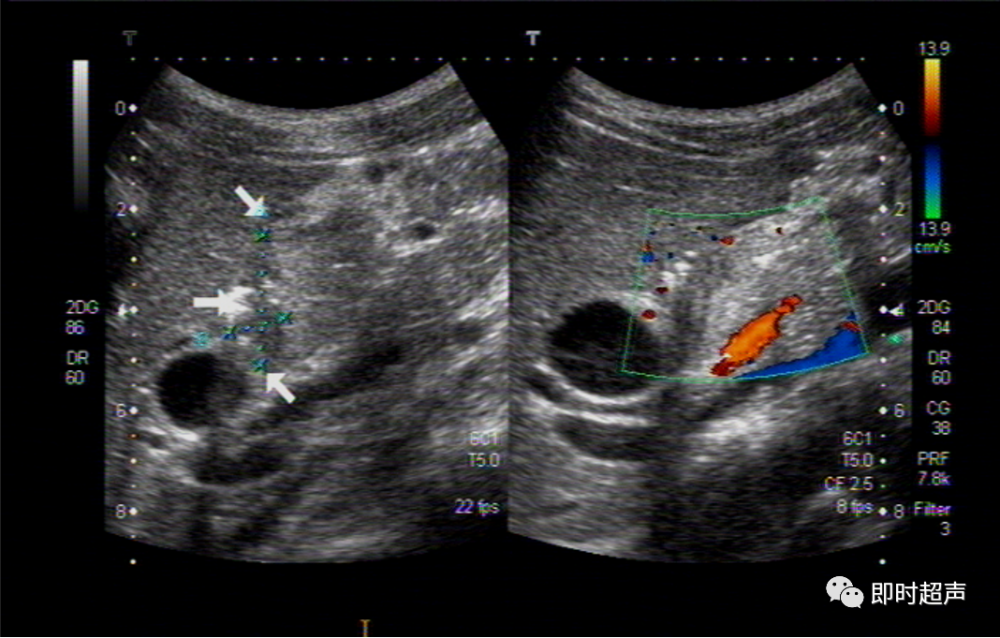 胃肠道穿孔超声检查诊断与定位