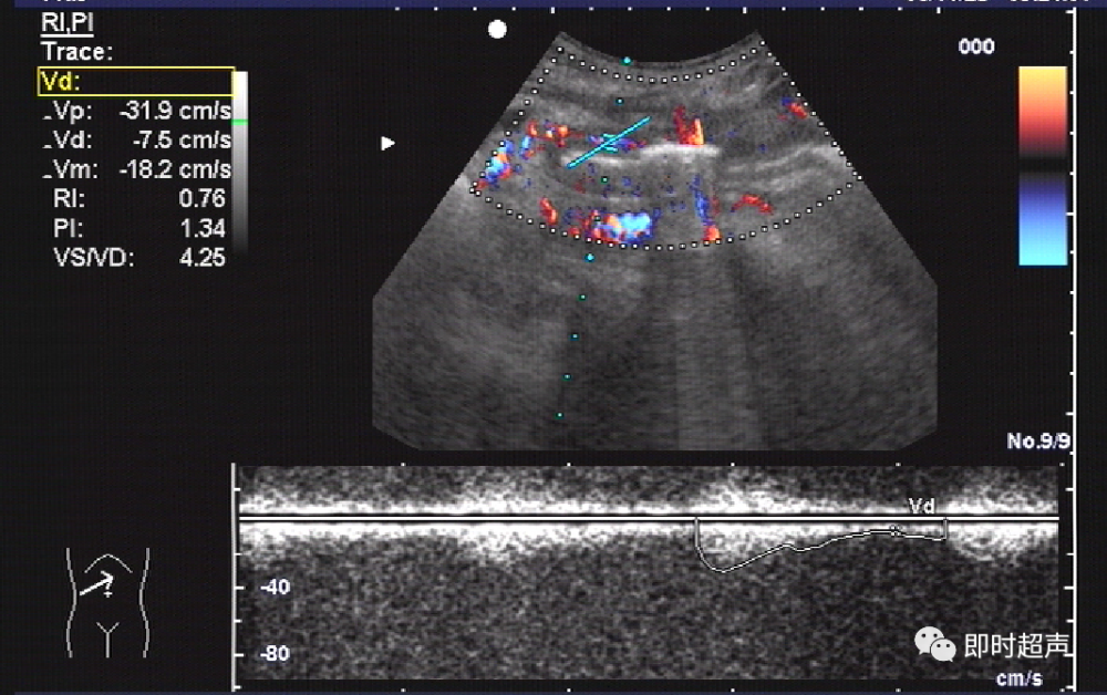 胃肠道穿孔超声检查诊断与定位_腾讯新闻