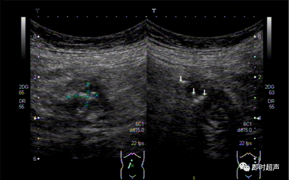 胃肠道穿孔超声检查诊断与定位_腾讯新闻