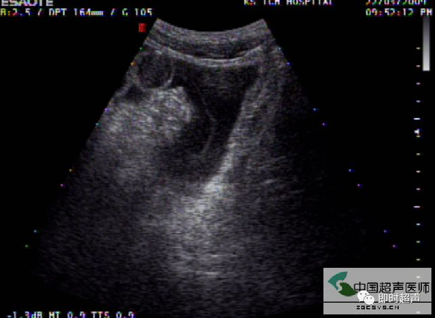 胃肠道穿孔超声检查诊断与定位_腾讯新闻