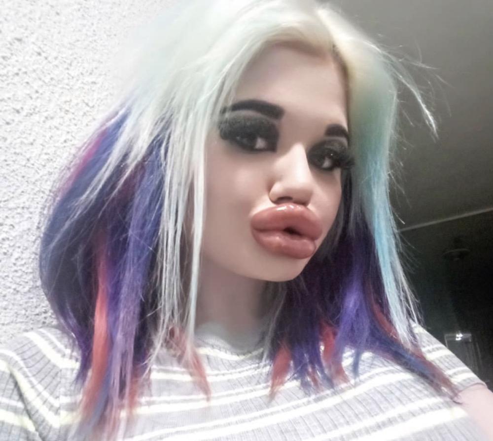 保加利亚少女想要世界最大嘴唇丰唇20次大到合不上仍不满足