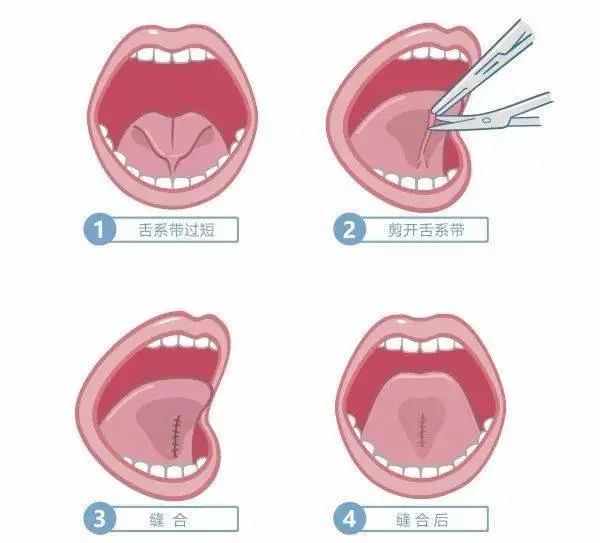 寶寶舌繫帶過短怎麼辦