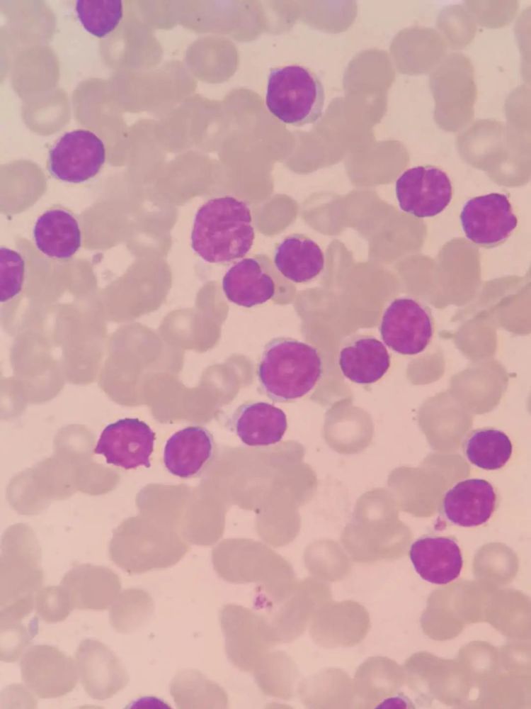 油镜下以成熟淋巴细胞为主,可见少量不典型淋巴细胞:低倍镜下骨髓增生