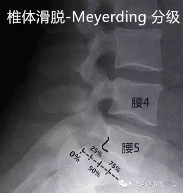 一文掌握 | 骶椎腰化/腰椎骶化,腰椎滑脱,腰肌劳损,简单易懂图解!