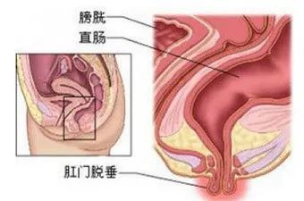 拉屎拉出u201c脱肛u201d，太痛苦了？_腾讯新闻