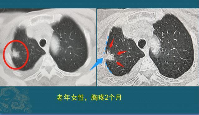 2厘米多的肺癌 一个治愈 另一个转移 只因有的癌细胞会修路 腾讯新闻